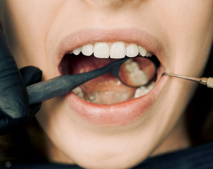 Scaling and root planing: what to expect during deep gum cleaning
